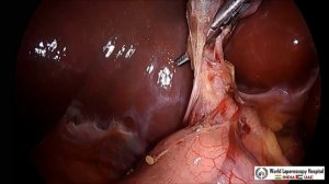 Laparoscopic Cholecystectomy Full Length Skin to Skin Video with Near Infrared Cholangiography