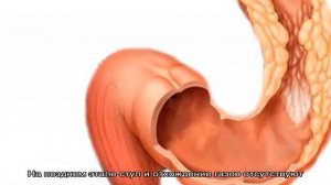 Симптомы и методы лечения спаечной непроходимости кишечника