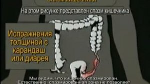 Смерть притаилась с толстой кишке? Зашлакованность кишечника