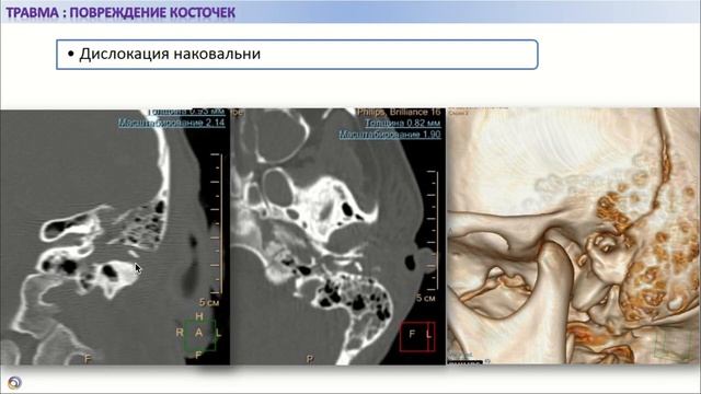 Травма височной кости: актуализация знаний смотреть онлайн