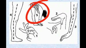 Гипермобильность суставов у детей