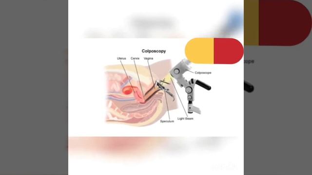 Для чего нужна кольпоскопия? смотреть онлайн