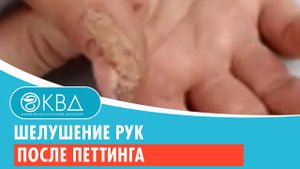Шелушение рук после петтинга. Клинический случай №74
