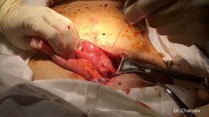 Прободная язва желудка