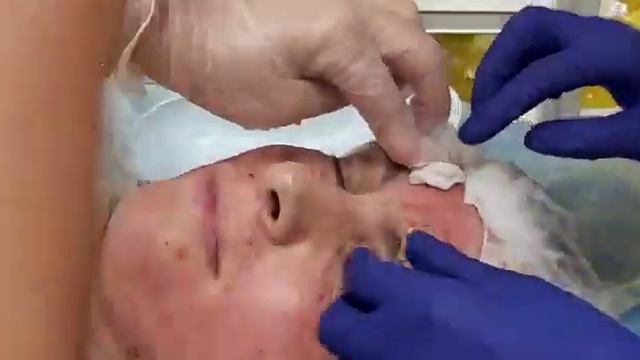 АирисКом студенты учатся: мезонити. Применение в области межбровье.