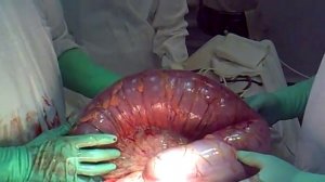 заворот кишки