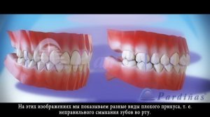 Неправильный прикус - Виды патологических прикусов ©