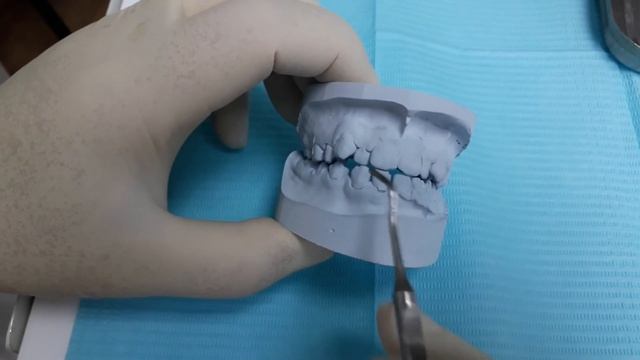 В каком возрасте можно приклеить брекеты? смотреть онлайн