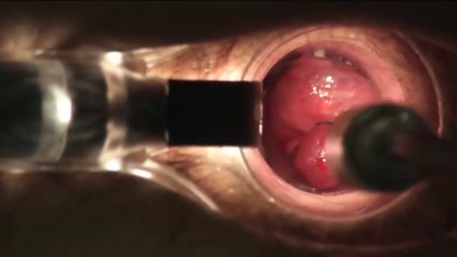 Лигирование латексными кольцами МЦ Аксон Балаково смотреть онлайн