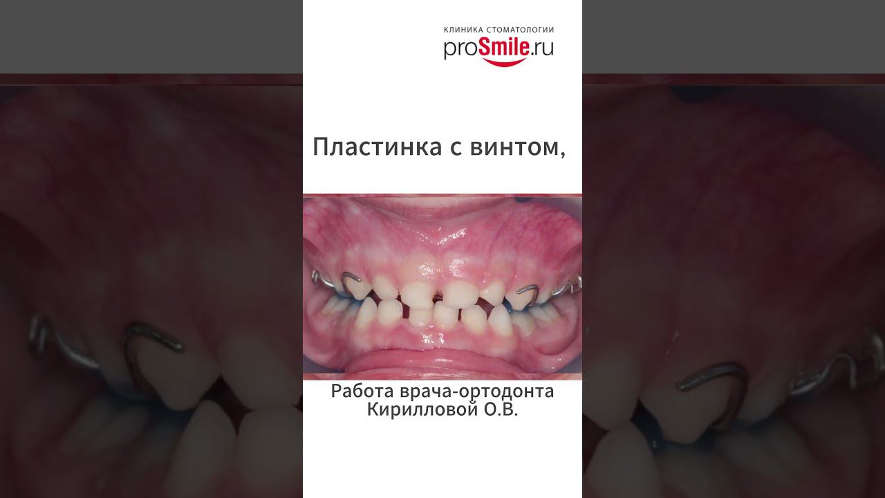 Лечение обратной резцовой окклюзии в молочном прикусе. Работа ортодонта Кирилловой О.В.