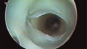 Нормальный венозный клапан-(350p25).mp4