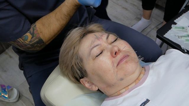 Акупунктурный лифтинг лица. Техники иглоукалывания для омоложения. Сокун Александр