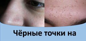 Черные точки на лице