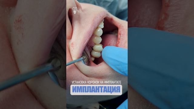Установка коронок на имплантате. Installation of crowns on the implant. Implantation.