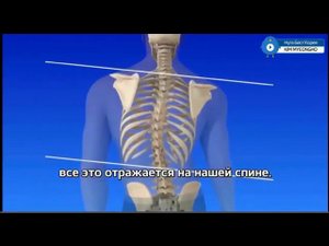 сколиоз