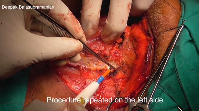 Ларингэктомия