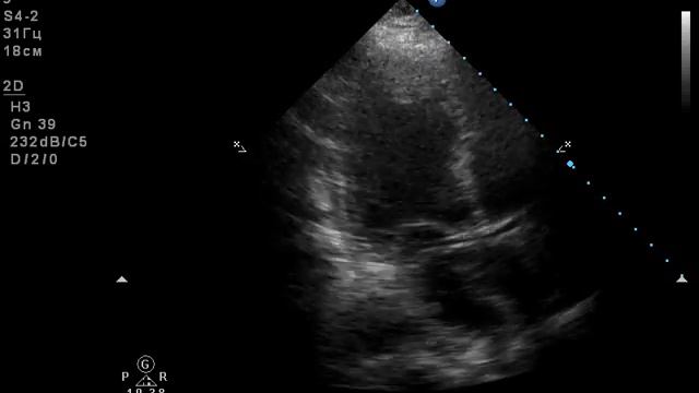 диссекция аорты4 смотреть онлайн