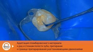 Клинический случай реставрация Полирен 2 Травлин адгезив композит А3 Полирен 3