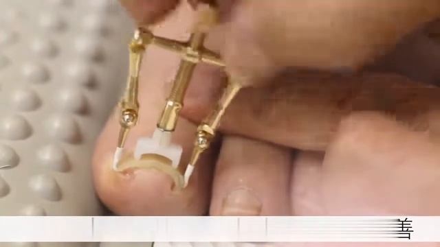 Врос ноготь. Что делать? Как лечить? Корректор вросшего ногтя/выпрямления ногтя