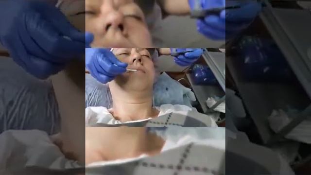 Ретиноловый пилинг смотреть онлайн