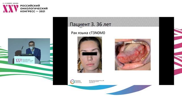 Рак слизистой оболочки полости рта. Гемиглоссэктомия. Применение лучевого лоскута смотреть онлайн