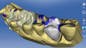 Что такое виниры? Александр Кирсанов