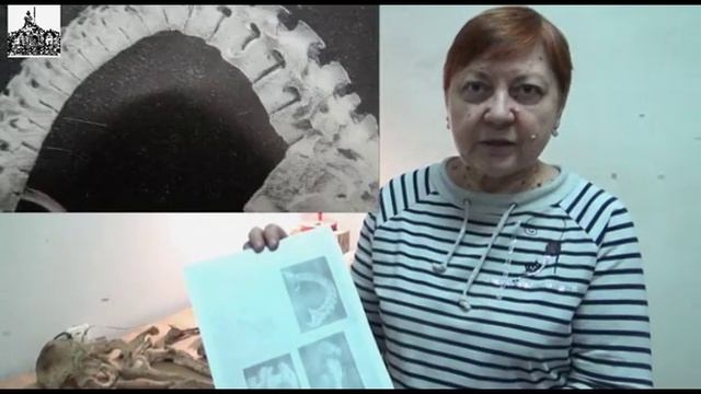 Старушка-меотка с болезнью Бехтерева смотреть онлайн