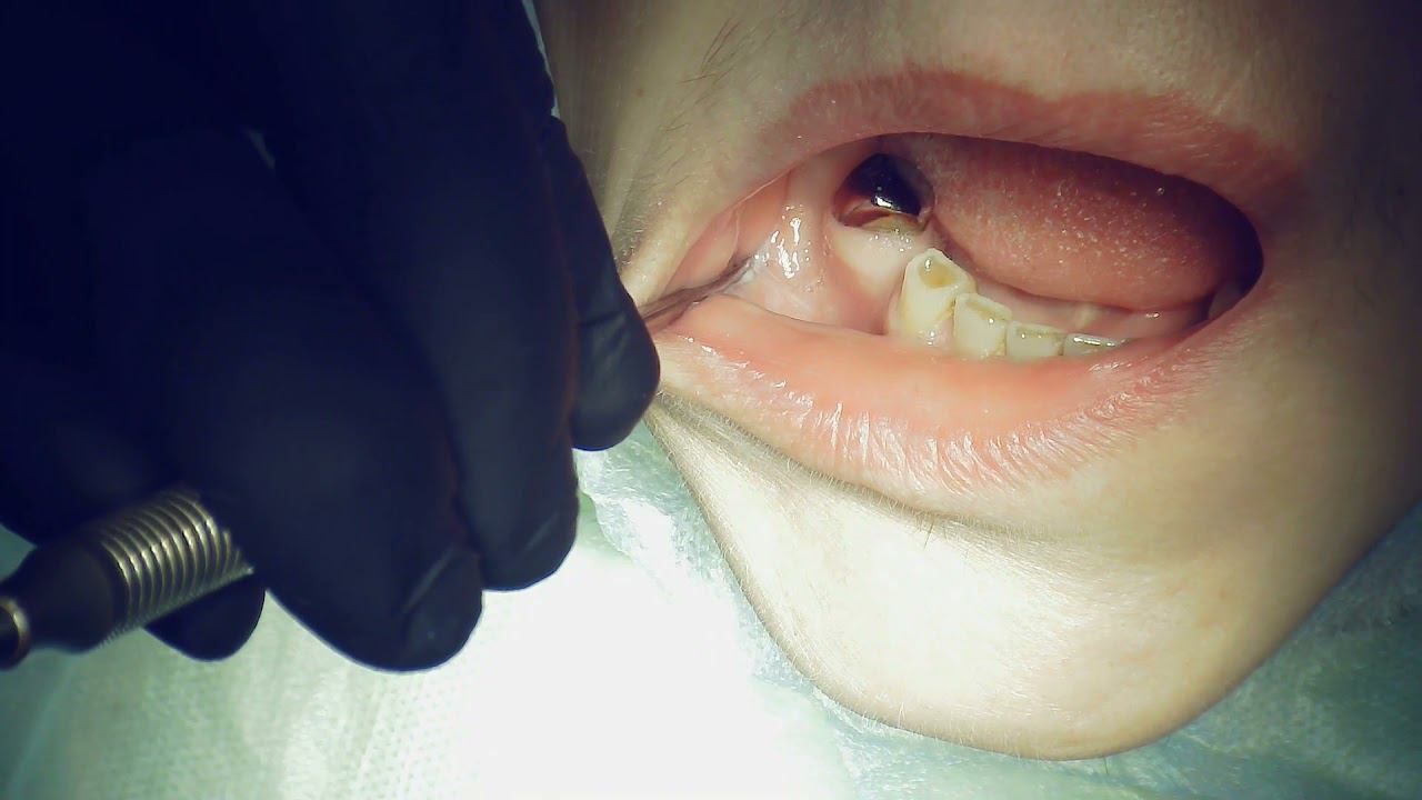 Conduction and infiltration anesthesia technique for implantation missing 4.4 and 4.6 teeth.