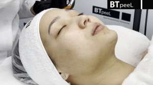 Процедура Фито пилинг AHA-кислоты с экстрактом клёна серебристого BTpeeL (сокращённая версия)