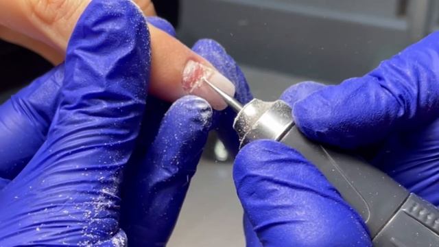 Онихомадезис. Зачистка. Работа фрезой продольно-поперечная смотреть онлайн