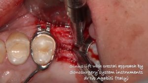 sinus lift titled mp4