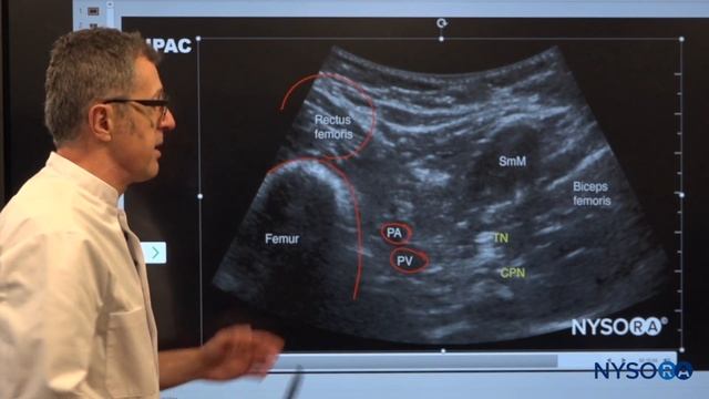 IPACK Block - Regional anesthesia Crash course with Dr. Hadzic