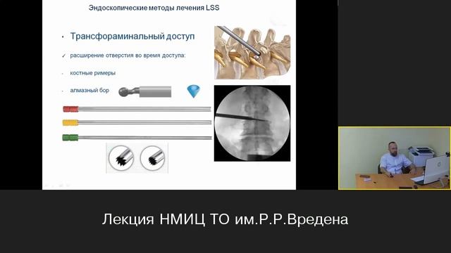 Сравнительная эффективность эндоскопического лечения различных вариантов стеноза позвоночного канала