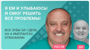 Все зубы за 1 день на 4-х имплантах Straumann