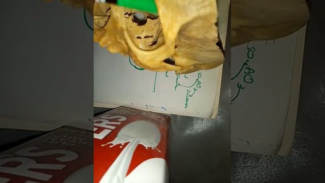 OPTIC NERVE in orbit easy description part 1orbital contents part 10 смотреть онлайн