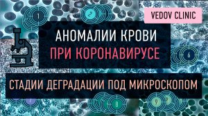 Как меняется кровь при коронавирусе. Исследования на японском микроскопе доктором Ведовым