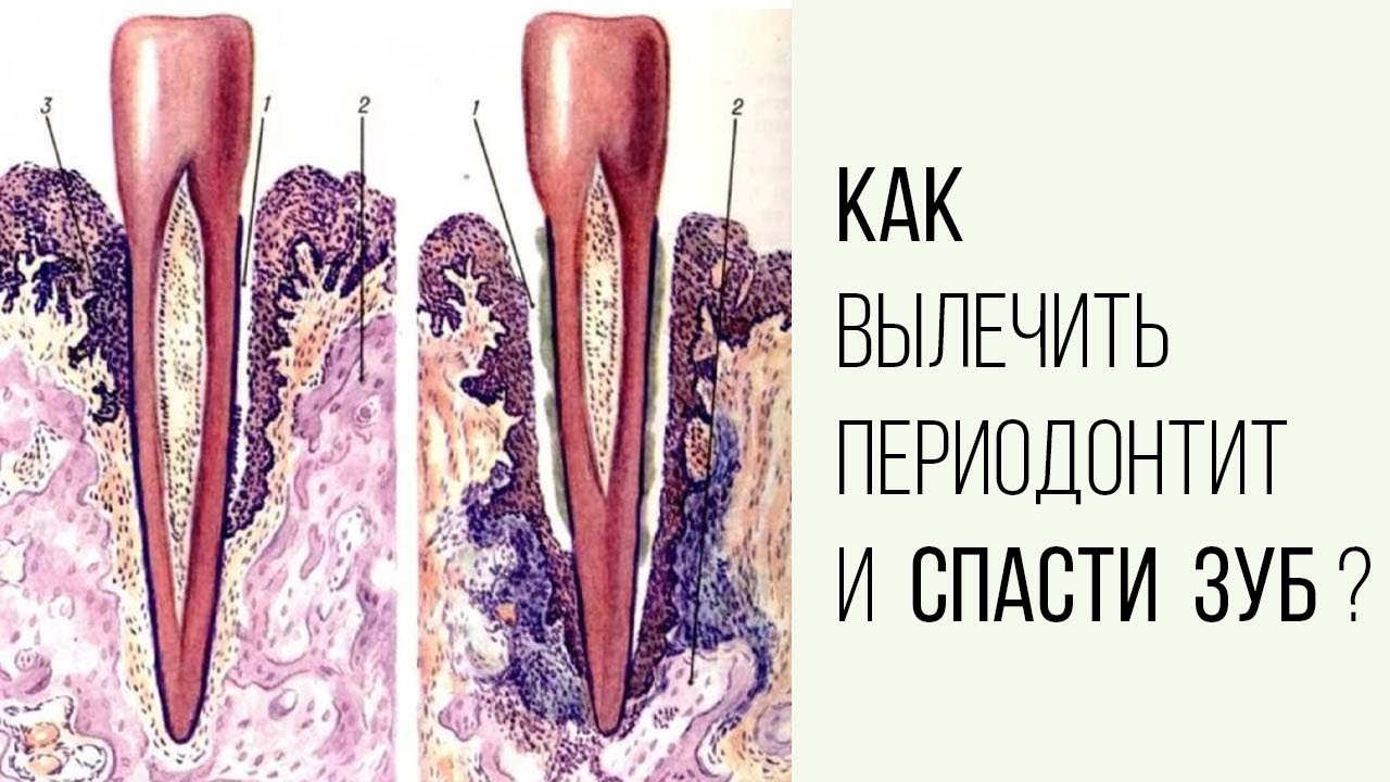 Периодонтит зуба как выглядит Как вылечить периодонтит и спасти зуб ❓ - смотреть видео онлайн от "НОВОДЕНТА+ с