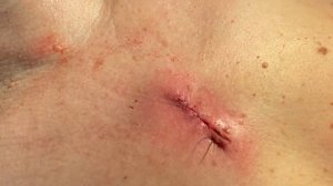 ЖИРовик, удаление и косметический шов