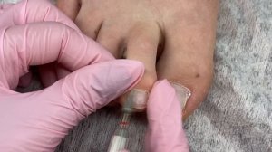 Онихолизис и огромная подногтевая мозоль?Педикюр на клиенте подробно