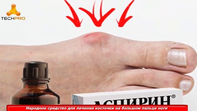 Народное Средство Для Лечения Косточки На Большом Пальце Ноги – топ лайфхаки смотреть онлайн