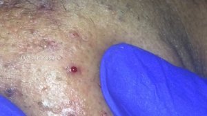 BLACKHEADS PART-2