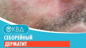 ? Себорейный дерматит. Клинический случай №201