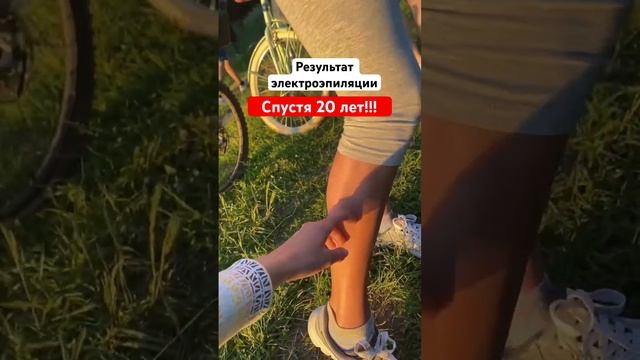 Ноги после электроэпиляции 20 лет назад! #электроэпиляция #обучениеэлектроэпиляции смотреть онлайн