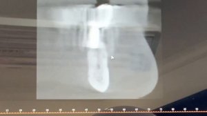 Периимплантит. История пациента.