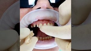 Коронки из Диоксид Циркония - примерка