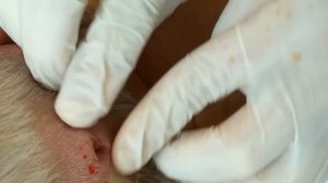 Squeezing  pimple, cyst, boil,zit/ Брызгающий прыщ.