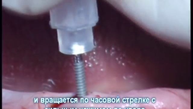 съёмный протез на мини-имплантах - нижняя челюсть смотреть онлайн