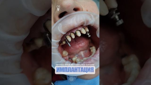 Обточка зубов. Реставрация и коронки. Teeth turning. Restoration and crowns. Implantation.