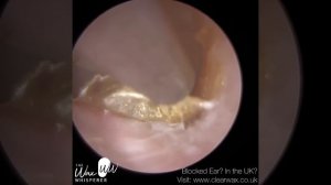 1,218 - Head Injury Ear Wax Removal in Fractured Ear Canal