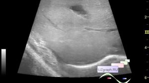 Детское УЗИ брюшной полости - Холелитиаз и гиперэхогенная стенка желчного пузыря